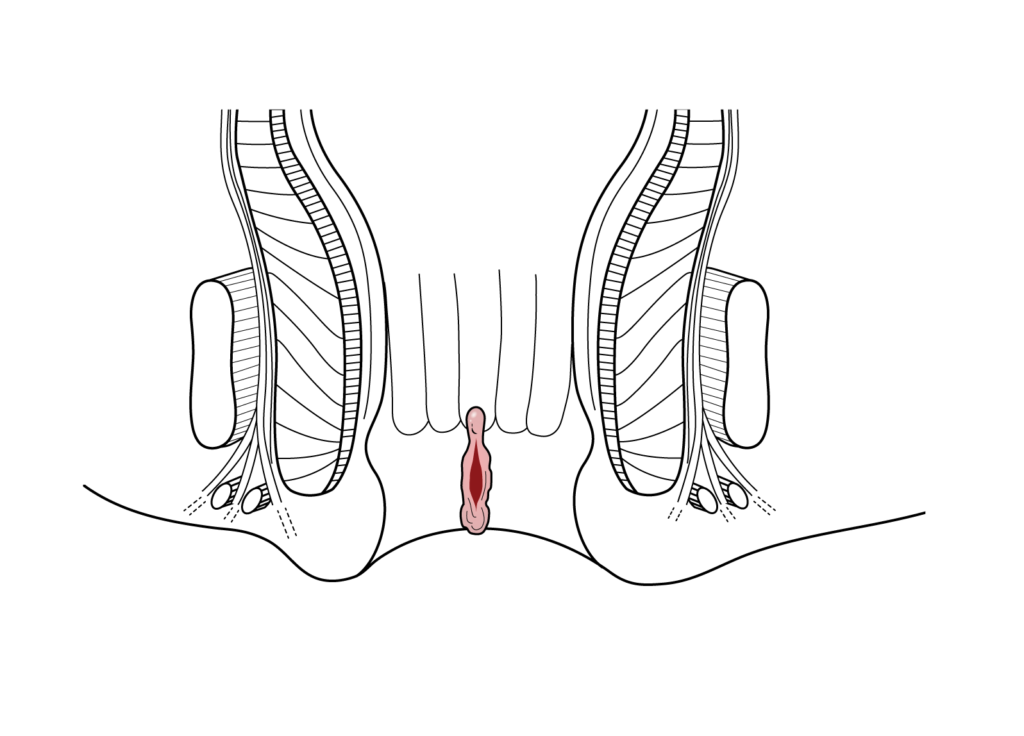 Anal Fissure