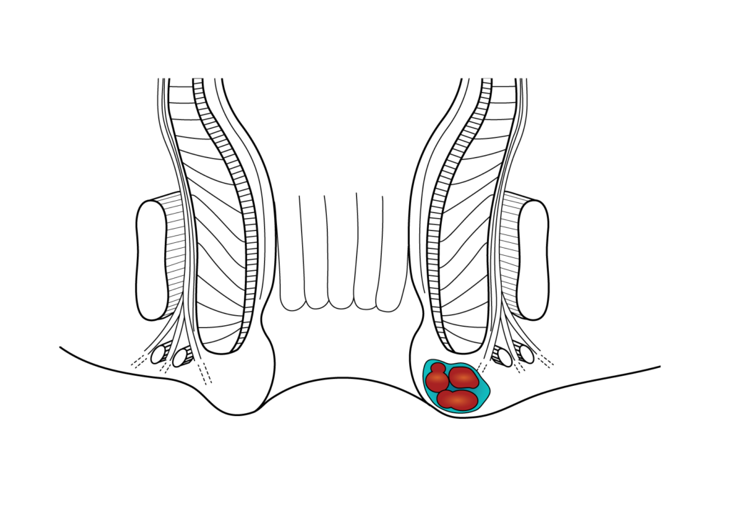 External Hemorrhoid
