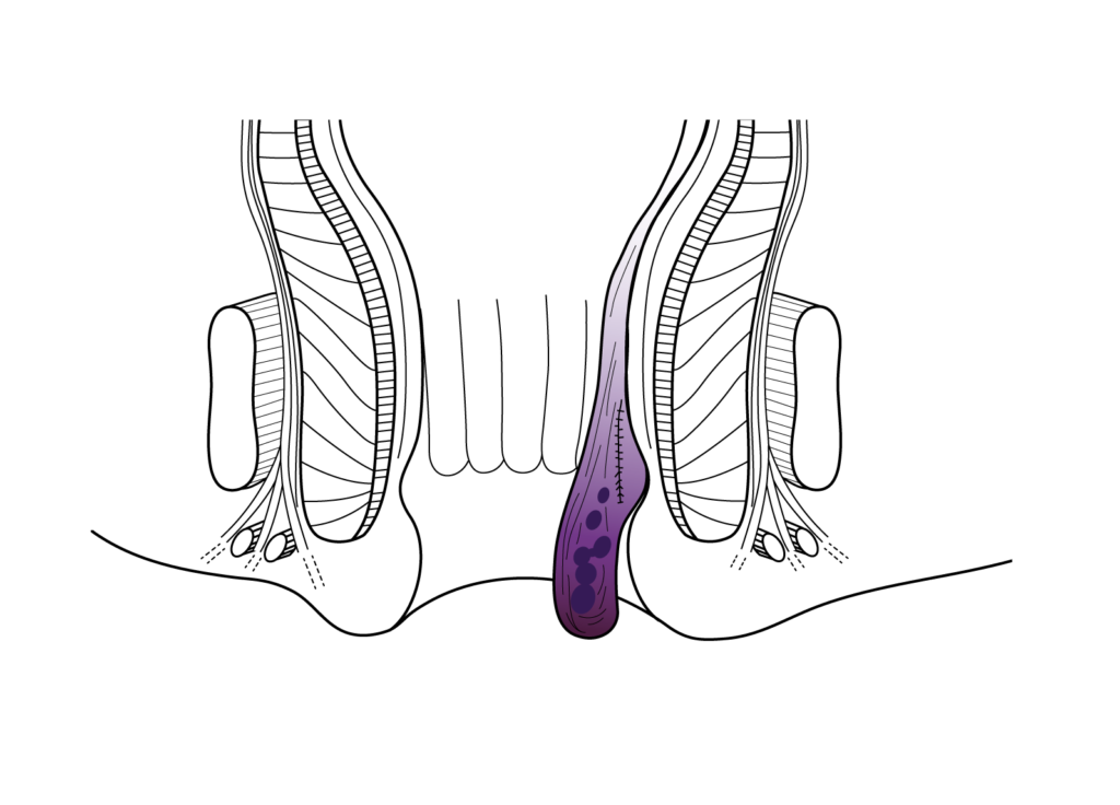 Prolapsed Internal hemorrhoid